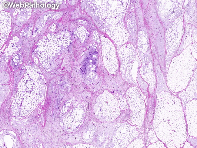 Soft Tissue_Lipomatous_Lipoblastoma33_resized.jpg